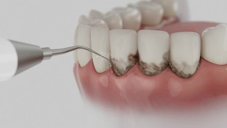 Trusted Wisdom Tooth Removal service in Redondo Beach, CA - Dentist Open Now